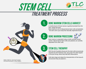 Stem Cell Therapy: A Breakthrough in Corneal Repair